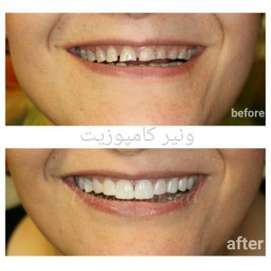 ونیر کامپوزیت